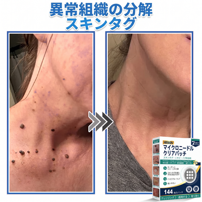 HISKIN® 2-in-1 マイクロニードル＆ハイドロコロイドパッチ｜盛り上がったほくろ・ニキビ・扁平いぼ・スキンタグをケア｜シワ・傷跡・シミを改善｜顔・体用 目立たないニキビパッチ