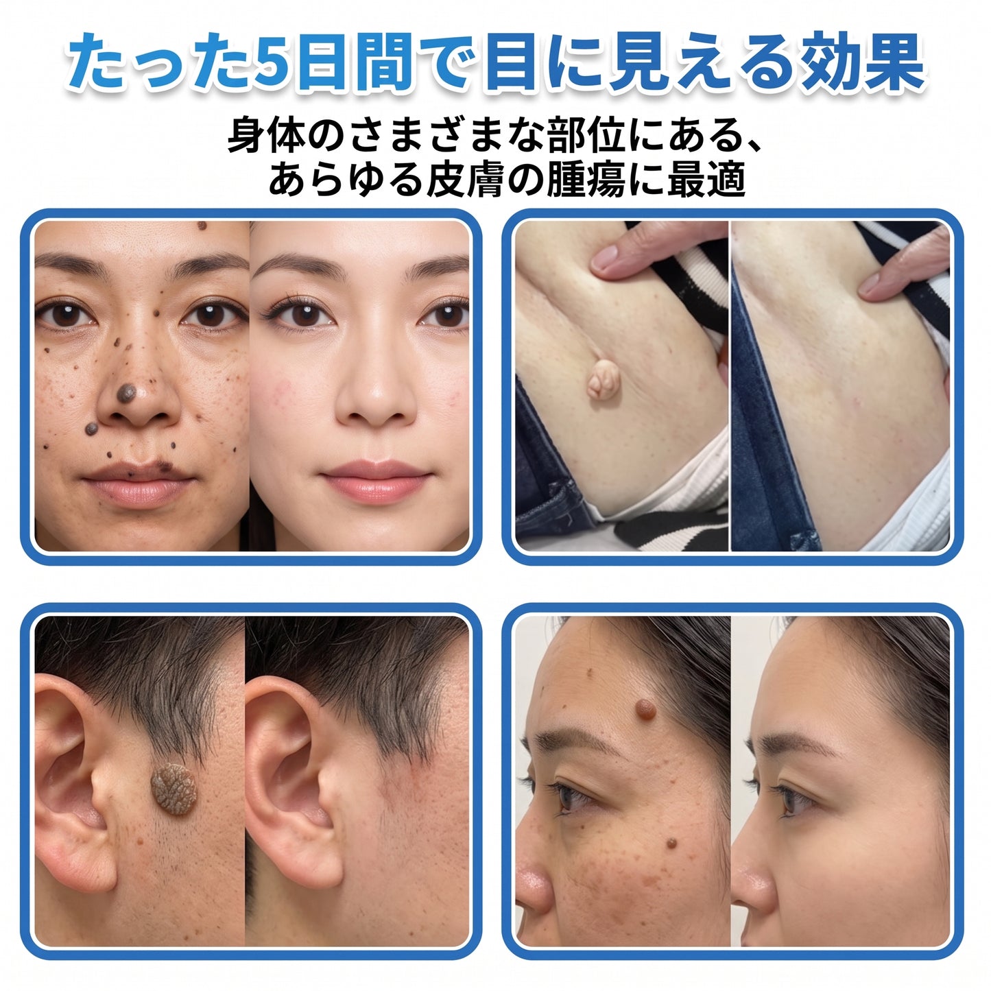 HISKIN® 2-in-1 マイクロニードル＆ハイドロコロイドパッチ｜盛り上がったほくろ・ニキビ・扁平いぼ・スキンタグをケア｜シワ・傷跡・シミを改善｜顔・体用 目立たないニキビパッチ